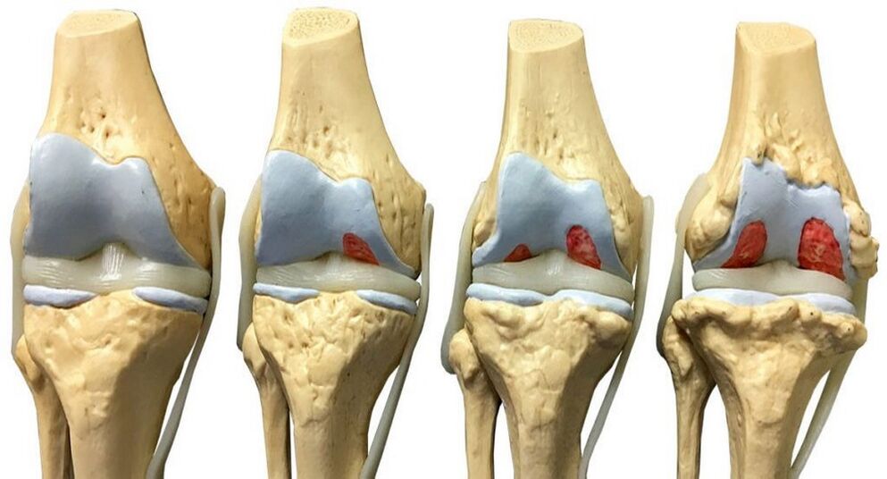 Osteoarthritis mit Hondrofrost behandelt werden