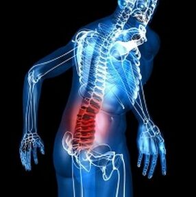 Osteochondrose