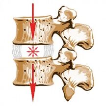 Das Gerät der Wirbelsäule und die Ursachen der Osteochondose