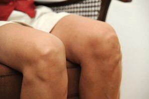 Schwellung des Kniegelenks aufgrund von Arthrose