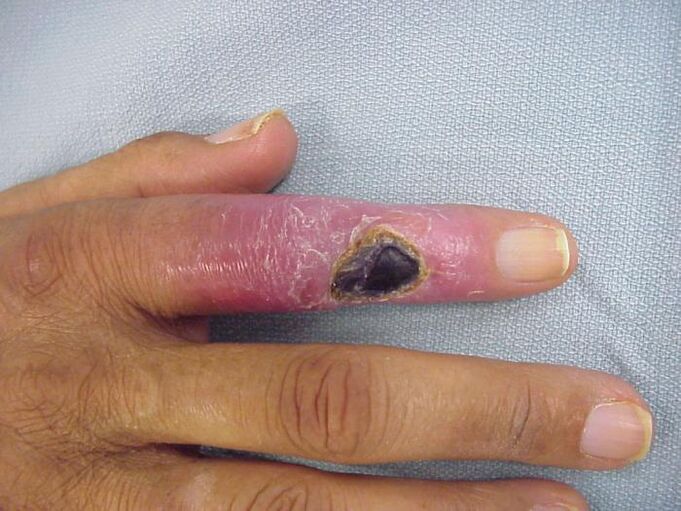 Osteomyelitis als Ursache für Fingergelenkschmerzen