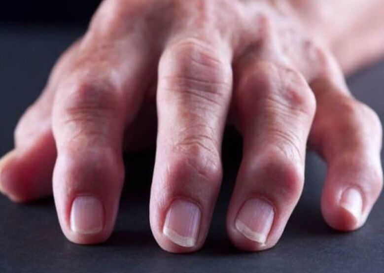 rheumatoide Arthritis als Ursache für Fingergelenkschmerzen