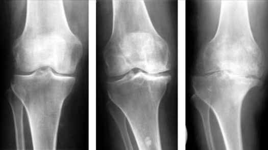 3 Stadien der Arthrose des Kniegelenks