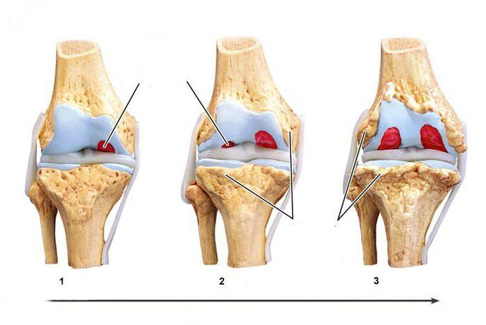 Grad der Entwicklung einer Gonarthrose