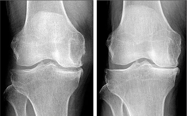 vor und nach der Behandlung von Osteoarthritis mit Hondrofrost